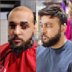 پروتز کف سر مردانه آنکارایی طبیعی (کد:1036)