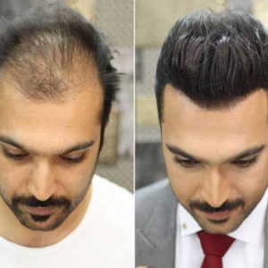 پروتز کف سر مردانه طبیعی خورشیدی (کد:1020)