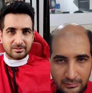 پروتز کف سر مردانه طبیعی لس آنجلسی(کد:1034)