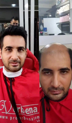 پروتز کف سر مردانه طبیعی لس آنجلسی(کد:1034)