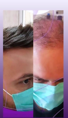 پروتز کف سر مردانه طبیعی لس آنجلسی(کد:1039)