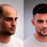 کلاه گیس مردانه کف سر لس انجلسی (کد:9101)
